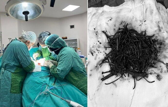 Doktorlar bile şaşırdı: Midesinden 1 kilo metal cisim çıktı!