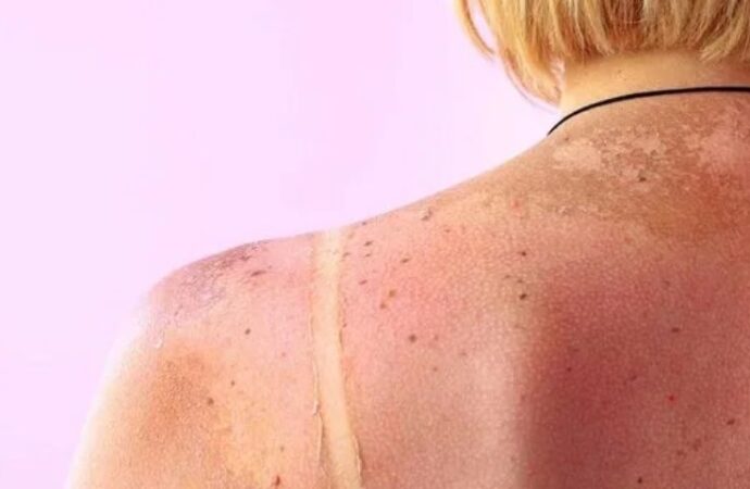 Güneş Lekelerine Elveda: Işıldayan Bir Cilt İçin Altın Öneriler